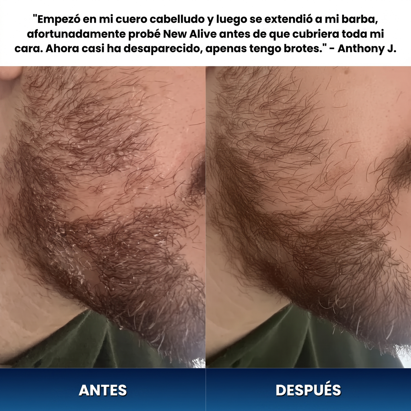 Crema Anticaspa para Barba y Cuero Cabelludo